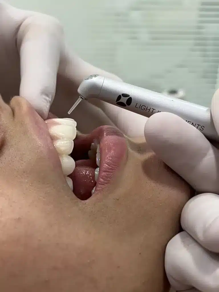 Laser LiteTouch