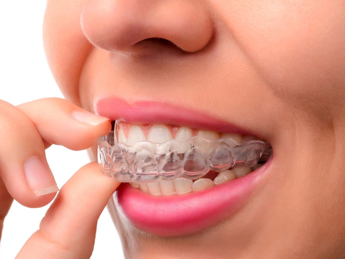 Ajuste fino oclusal e funcional